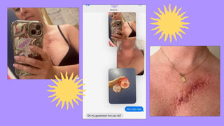 Our Co-Founder Maddy's Journey with Skin Cancer: A Personal Story