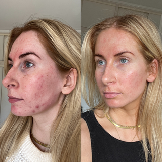 How to Self Tan with Acne-Prone Skin: Safe Techniques